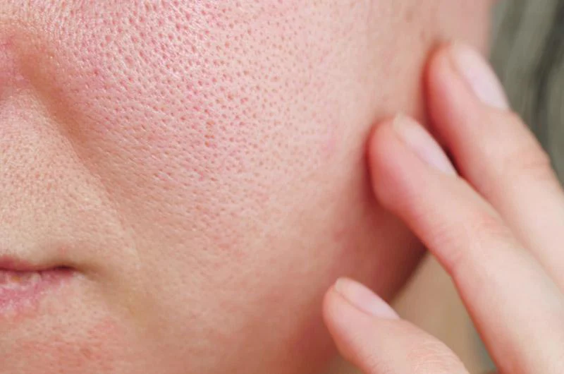 Enlarged PORES is bothering you ?